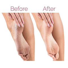 Electric Pedicure Foot File Callus Remover